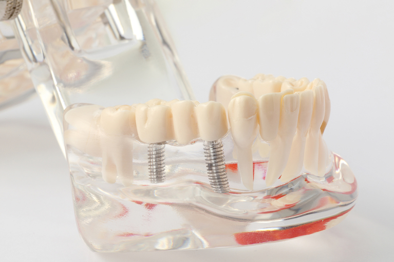 人工的に失った歯を再生する治療法です
